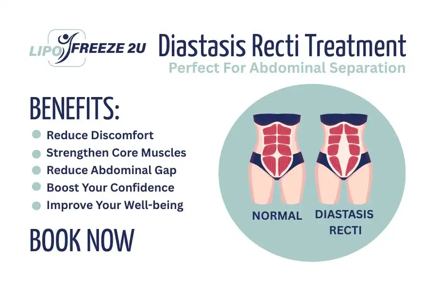 Benefits of body toning treatment Maidstone for Diastasis recti