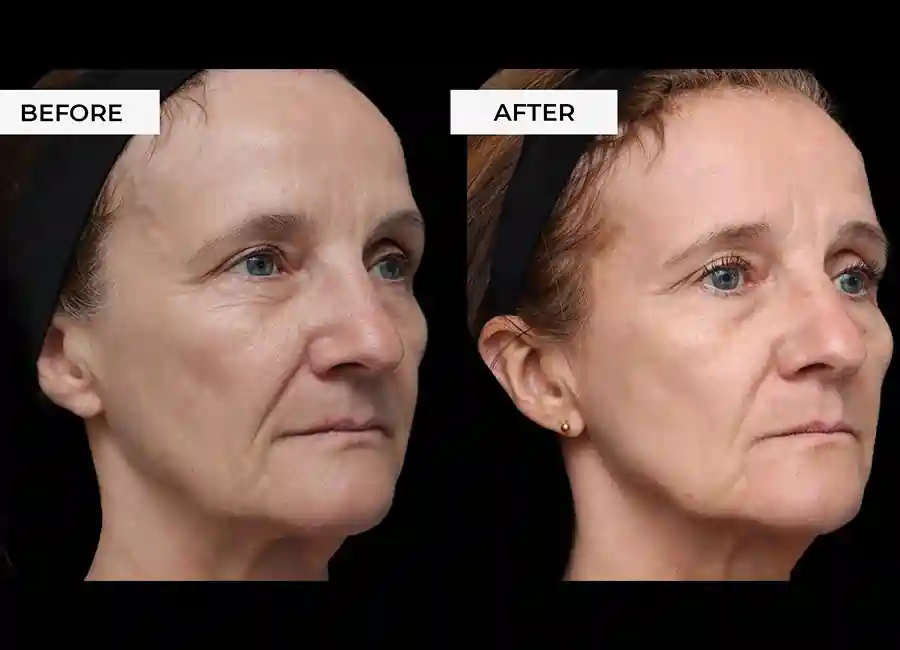 How Many RF Microneedling Sessions Will You Need to See a Difference Maidstone?