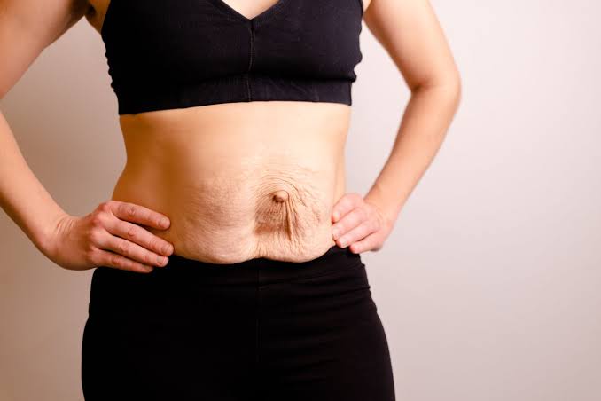 Is Surgery Really the Only Way to Repair Diastasis Recti Maidstone?