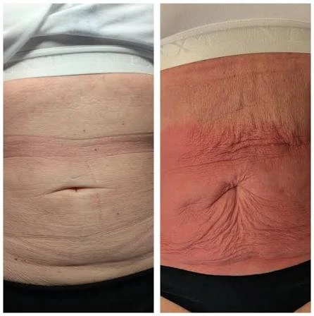 How Does RF Microneedling Improve Crepey, Thin and Uneven Skin Texture Maidstone?
