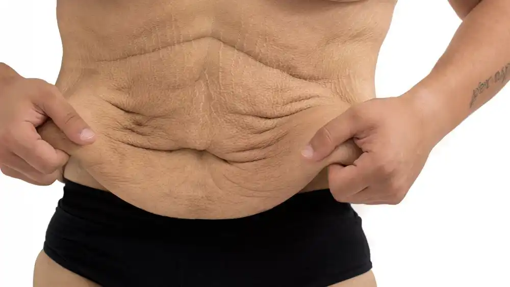RF Microneedling for Loose Skin: How Can It Help Tighten and Reshape the Skin Maidstone?